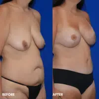 OLD FMPS B&A Template - mommy makeover (2)