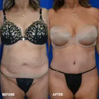 OLD FMPS B&A Template - TT W/ Flank Lipo OLD FMPS B&A Template - TT W/ Flank Lipo