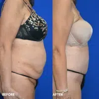 OLD FMPS B&A Template - TT W/ Flank Lipo (2) OLD FMPS B&A Template - TT W/ Flank Lipo (2)