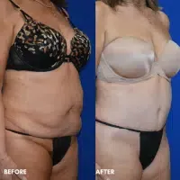 OLD FMPS B&A Template - TT W/ Flank Lipo (3) OLD FMPS B&A Template - TT W/ Flank Lipo (3)