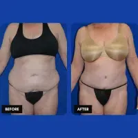 OLD FMPS B&A Template- Sanderson & Braswell Patients - 2025-09-25-tummytuck-liposuctionoftheflanks-01 OLD FMPS B&A Template- Sanderson & Braswell Patients - 2025-09-25-tummytuck-liposuctionoftheflanks-01