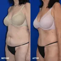 OLD FMPS B&A Template - TT w/ flank lipo (2) OLD FMPS B&A Template - TT w/ flank lipo (2)