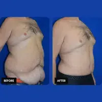 OLD FMPS B&A Template - extended TT, flank lipo, fleur-de-lis (2) OLD FMPS B&A Template - extended TT, flank lipo, fleur-de-lis (2)