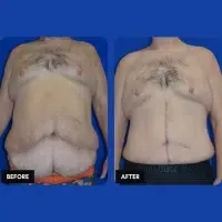 OLD FMPS B&A Template - extended TT, flank lipo, fleur-de-lis OLD FMPS B&A Template - extended TT, flank lipo, fleur-de-lis