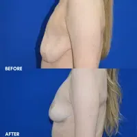 OLD FMPS B&A Template- Sanderson & Braswell Patients - 10-16-25-mastopexy-01 (2)