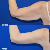 OLD FMPS B&A Template - brachioplasty (2)