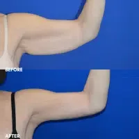 OLD FMPS B&A Template - brachioplasty