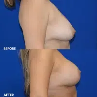 OLD FMPS B&A Template - breast aug with a lift (3)