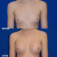 FMPS B&A Template - Breast aug