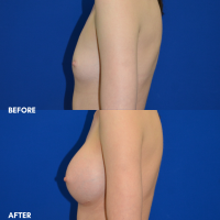 FMPS B&A Template - Breast aug
