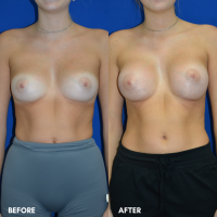 FMPS B&A Template - breast augmentation