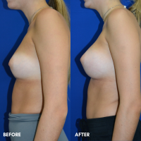 FMPS B&A Template - breast augmentation