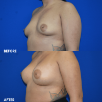 FMPS B&A Template - breast augmentation