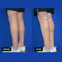 FMPS B&A Template - calf implants