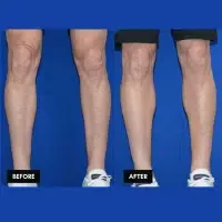 FMPS B&A Template - calf implants