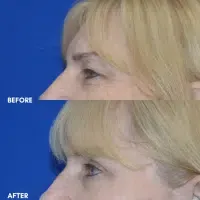OLD FMPS B&A Template - upper bleph (2)