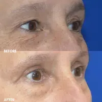 OLD FMPS B&A Template- Sanderson & Braswell Patients - 2025-09-18-upperbleph-02