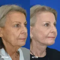 FMPS B&A Template - deep laser resurfacing/ lower face and necklift/ upper bleph (2)