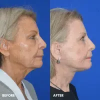 FMPS B&A Template - deep laser resurfacing/ lower face and necklift/ upper bleph (3)