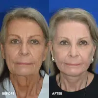FMPS B&A Template - deep laser resurfacing/ lower face and necklift/ upper bleph